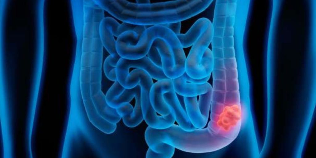 Trajtimi i kancerit kolorektal