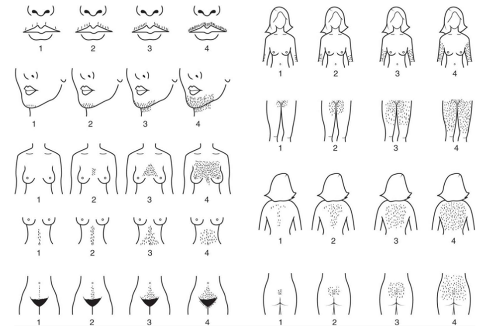 Hirsutizmi - qimet e padëshiruara te gratë