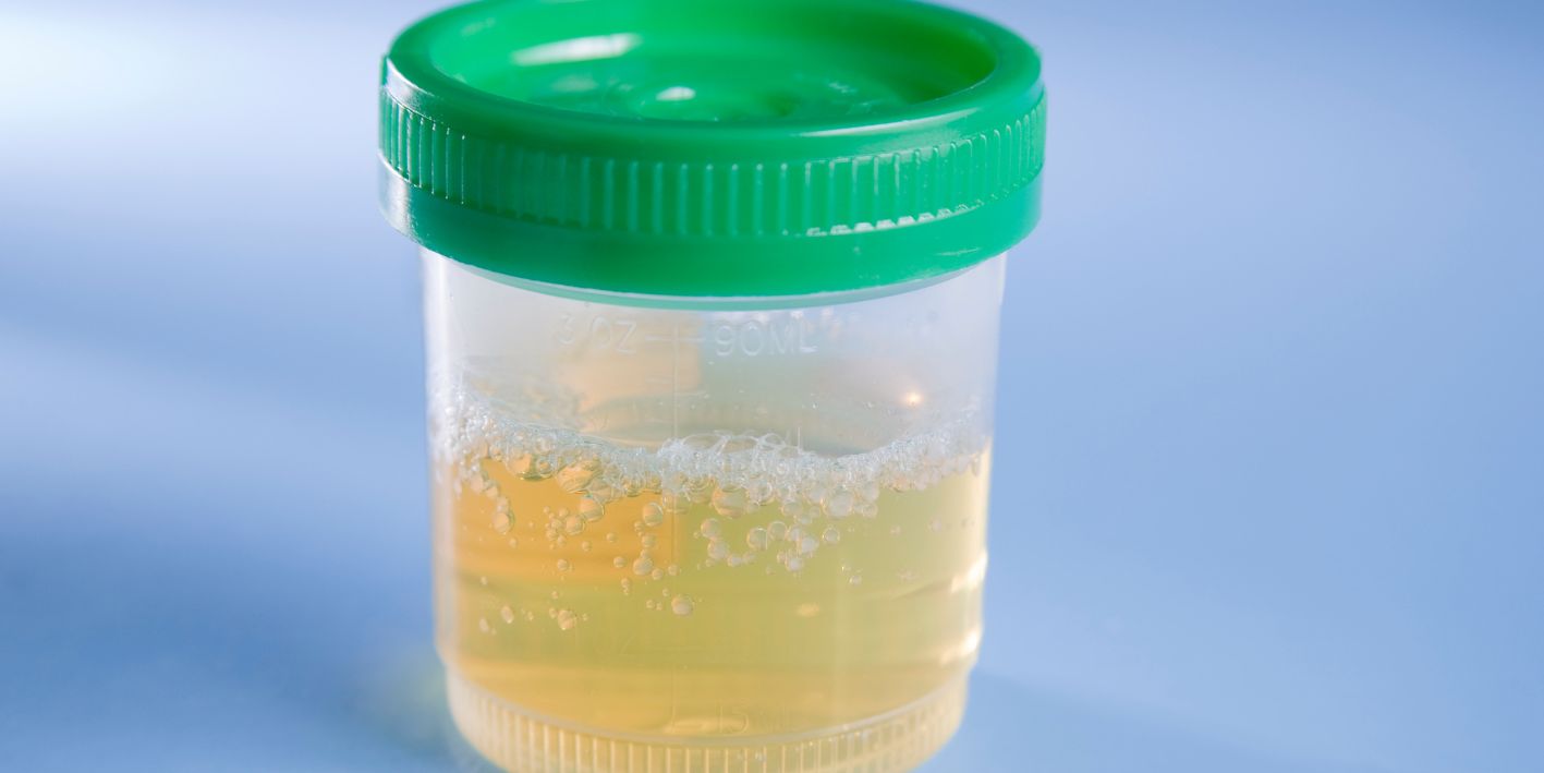 Sindromi nefrotik, albumina në urinë