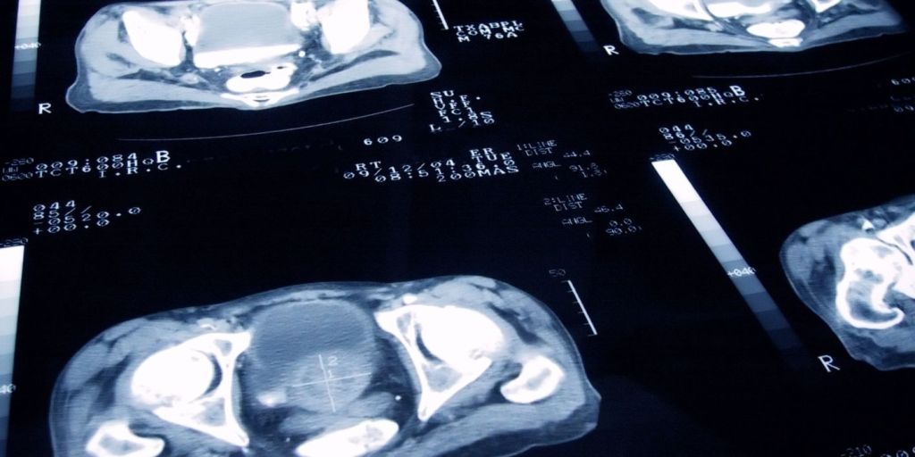 PSMA PET-CT Kancer Prostate