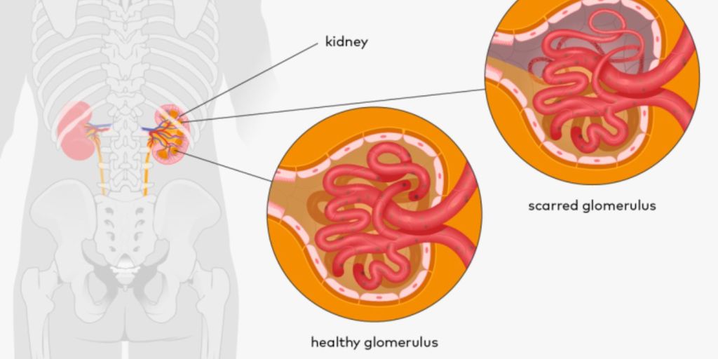 Glomeruloskleroza segmentale fokale