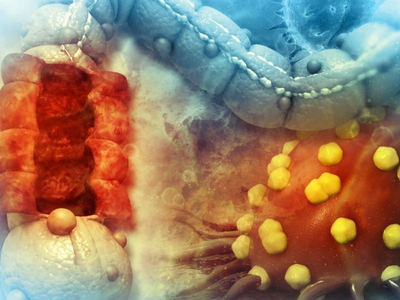 Kanceri kolorektal i moshave të reja – shqetësim i ri për&nbsp;onkologët
