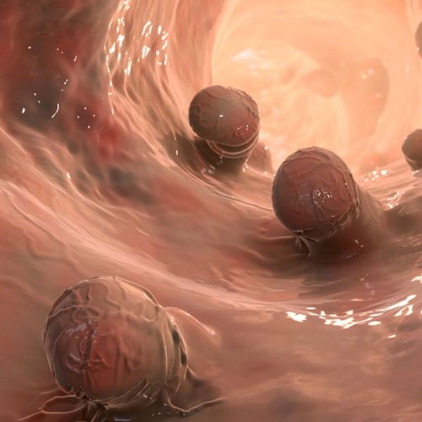 Kanceri kolorektal: dyfishohet incidenca në moshat e&nbsp;reja