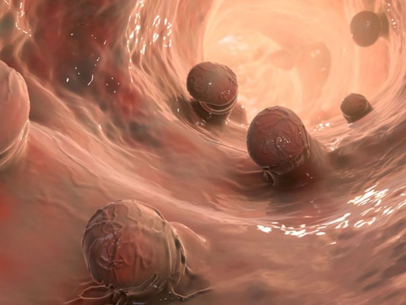 Kanceri kolorektal: dyfishohet incidenca në moshat e&nbsp;reja