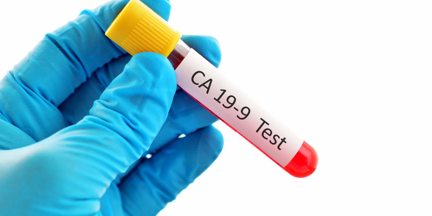 Çfarë tregon analiza CA 19-9?