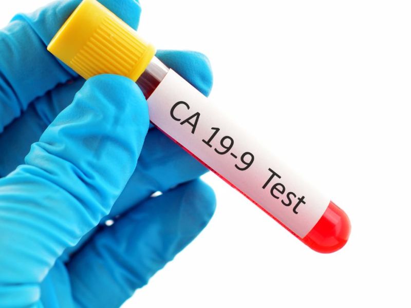 Çfarë tregon analiza CA&nbsp;19-9?