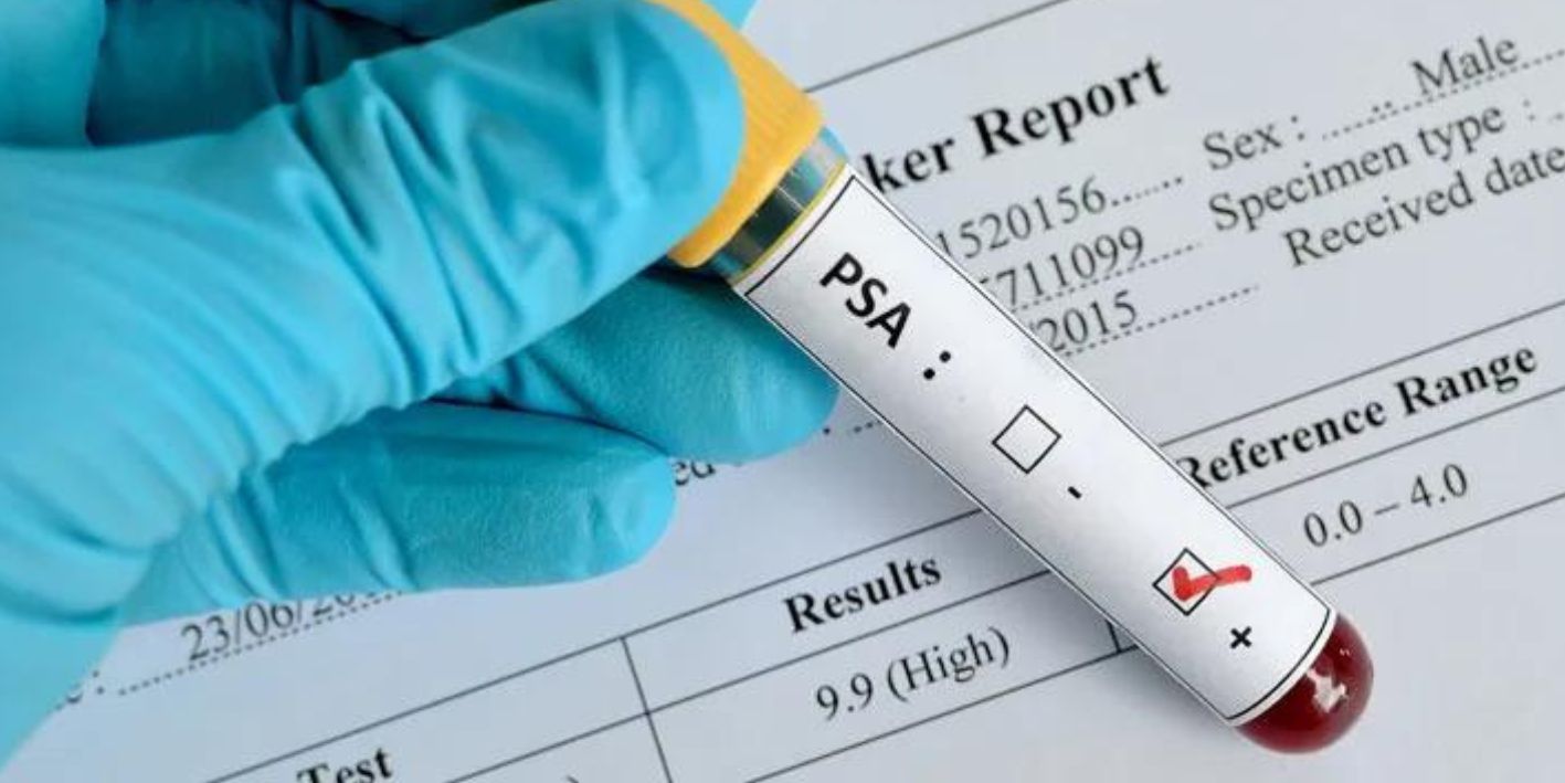 Diagnostikimi i kancerit te prostates: Roli i PSA