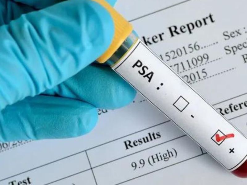 Diagnostikimi i kancerit të prostatës: Roli i&nbsp;PSA