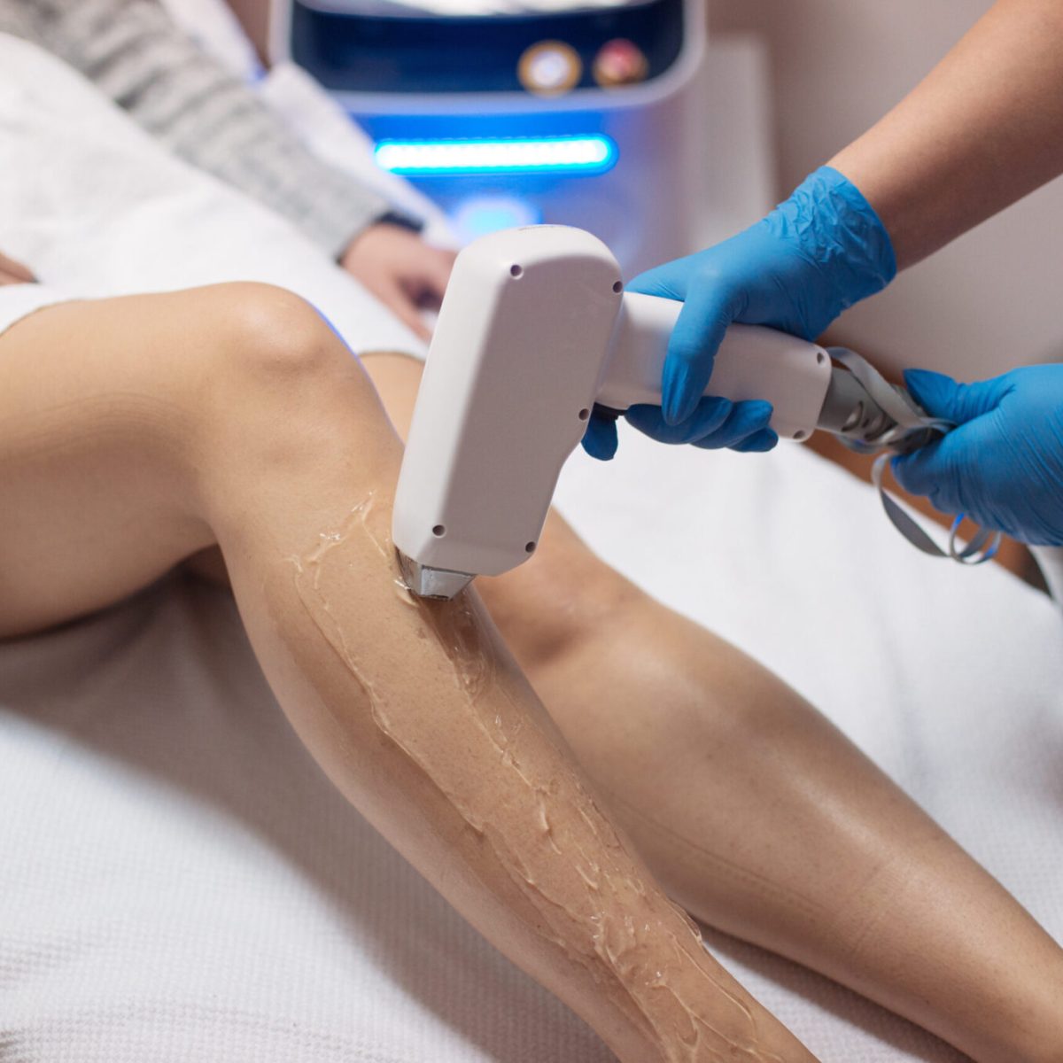 Terapia me lazer për hirsutizmin, një zgjidhje&nbsp;efikase?