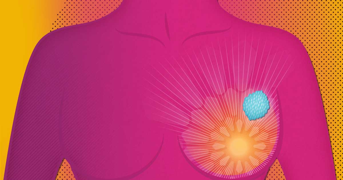 Kanceri i gjirit - te rejat mbi trajtimin dhe diagnostikimin