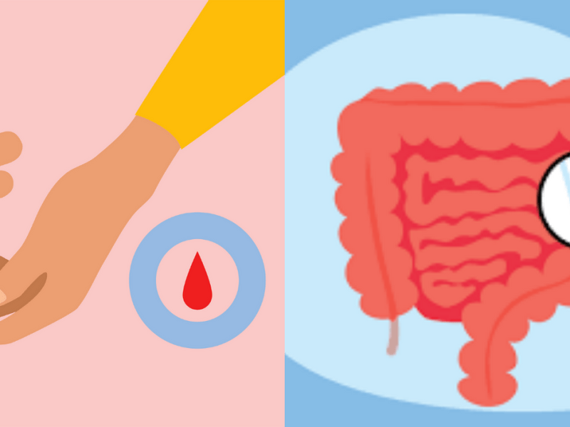 A është diabeti faktor risku për kancerin&nbsp;kolorektal?