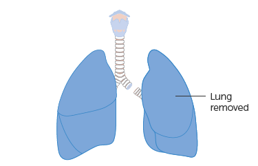 Pneumonektomia - kanceri i mushkerise