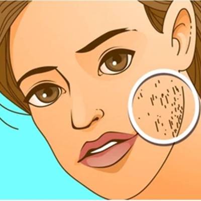 Hirsutizmi, qimëzimi i shtuar te&nbsp;femrat