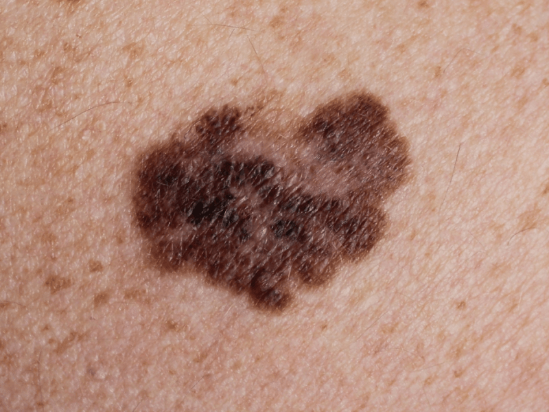 Si diganostikohet melanoma?