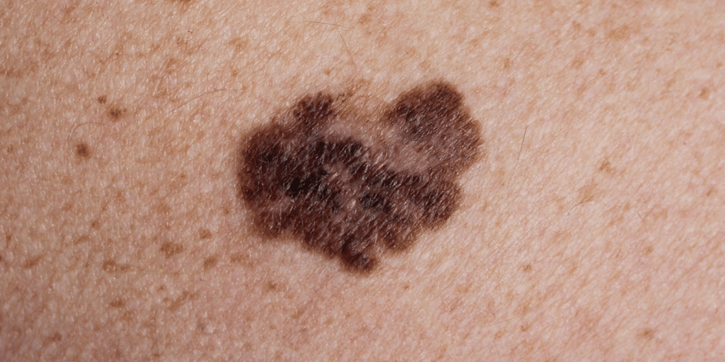 Melanoma - diagnostikimi