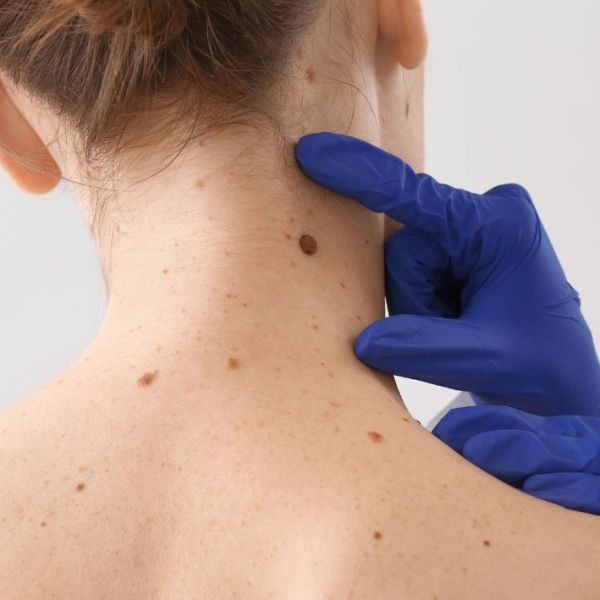 Kur duhet të shqetësoheni për&nbsp;nishanet?