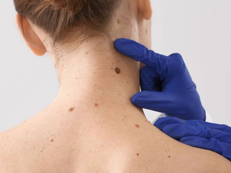 Kur duhet të shqetësoheni për&nbsp;nishanet?