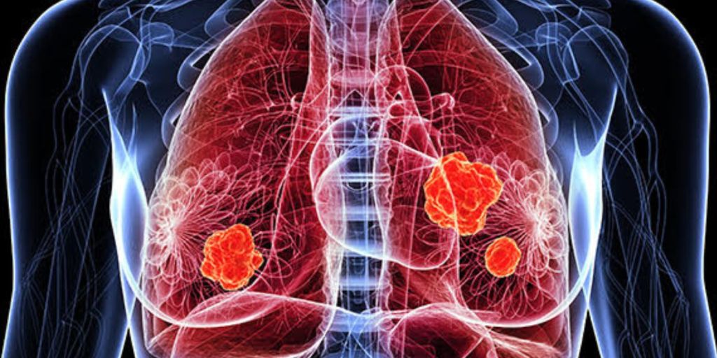 Abemaciclib ne kombinim me terapi endokrine per trajtimin e kancerit te hershem te gjirit