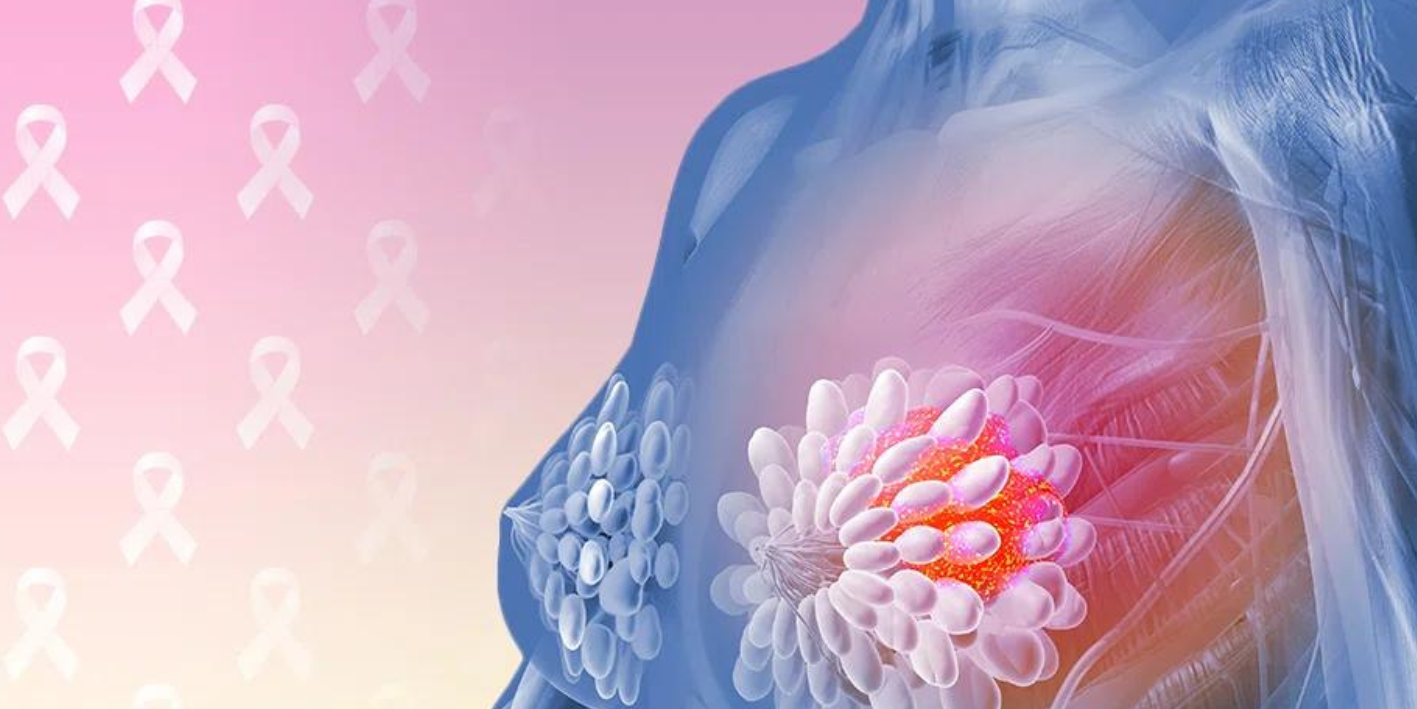 Ribociclib në kancerin e hershëm të gjirit - studimi NATALEE