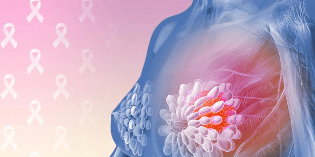 Ribociclib në kancerin e hershëm të gjirit - studimi NATALEE