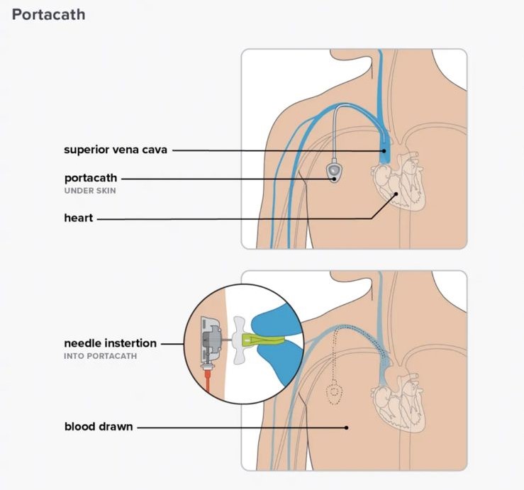 Portacath - aplikimi i kimioterapise ne port