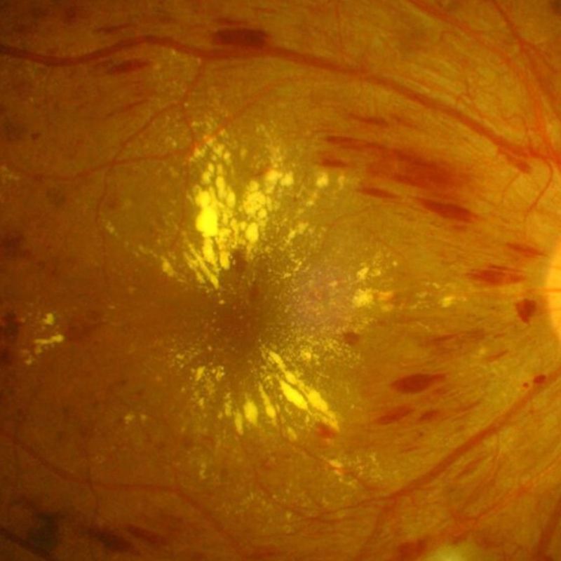 Retinopatia diabetike dhe kontrolli i&nbsp;syve