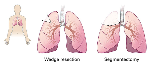 Kirurgjia e kancerit te mushkerise