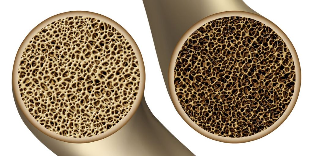 kanceri i gjirit densiteti kockor