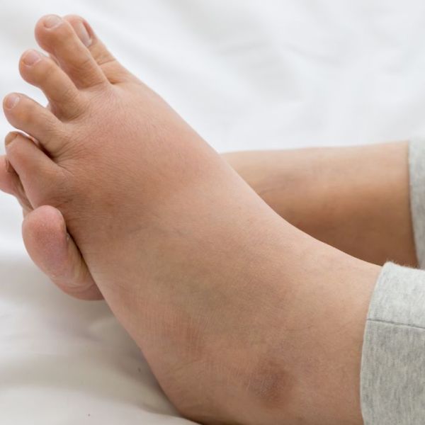 Çfarë jane edemat periferike ose ënjtja e këmbëve ose&nbsp;duarve