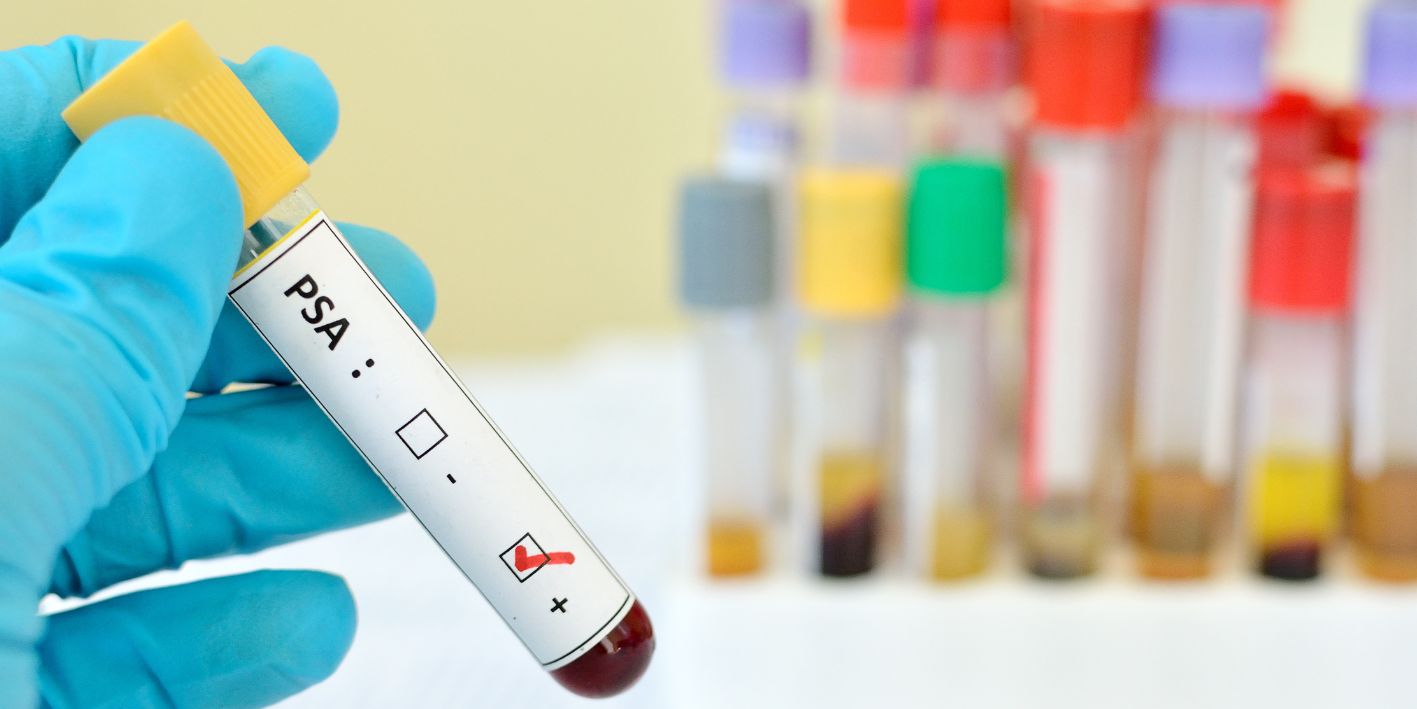 PSA - rekurrenca biokimike