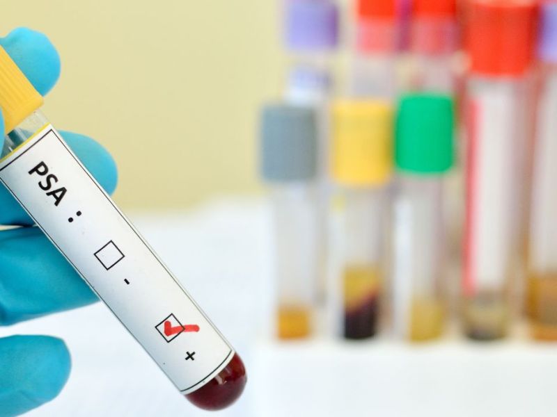 Si të interpretojmë nivelin e PSA pas prostatektomisë?