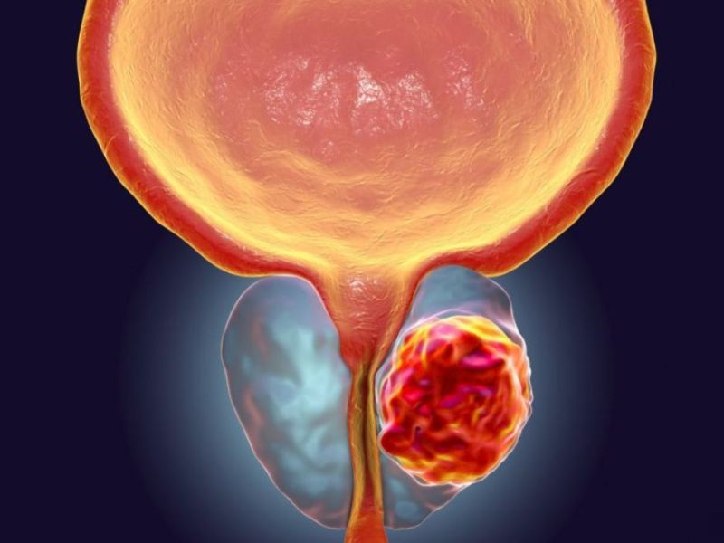 Trajtimi i kancerit të&nbsp;prostatës