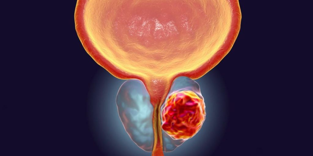 Trajtimi i kancerit të prostatës.