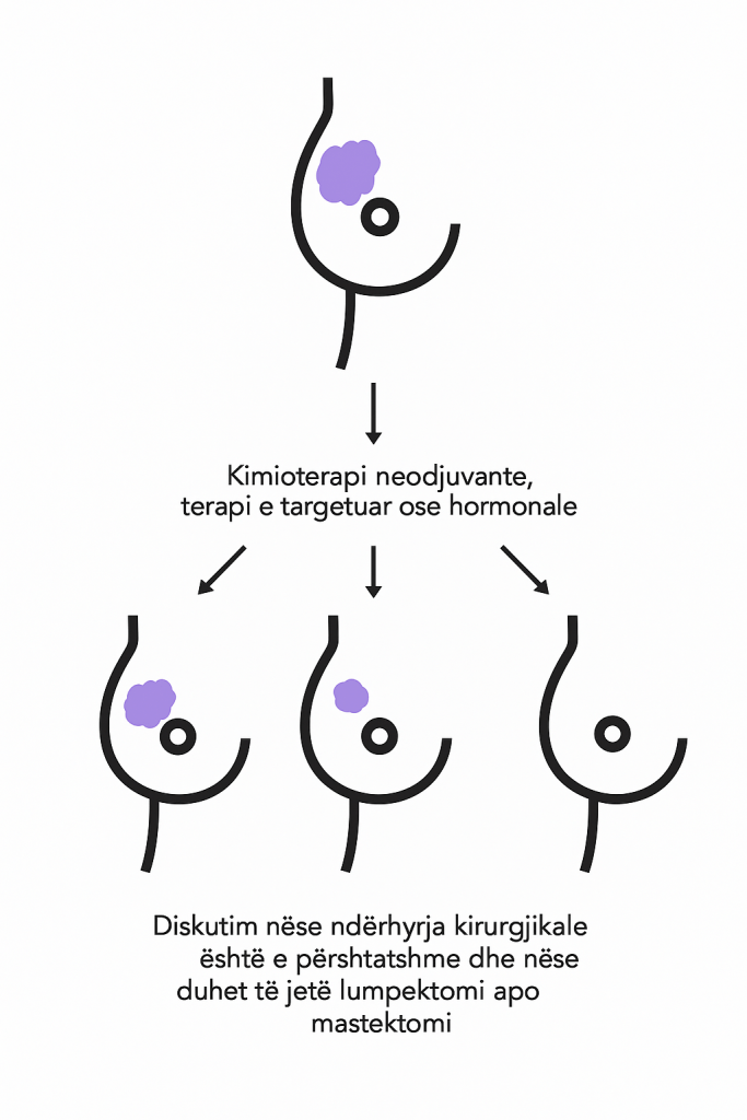 Terapia neoadjuvante ne kancerin e gjirit